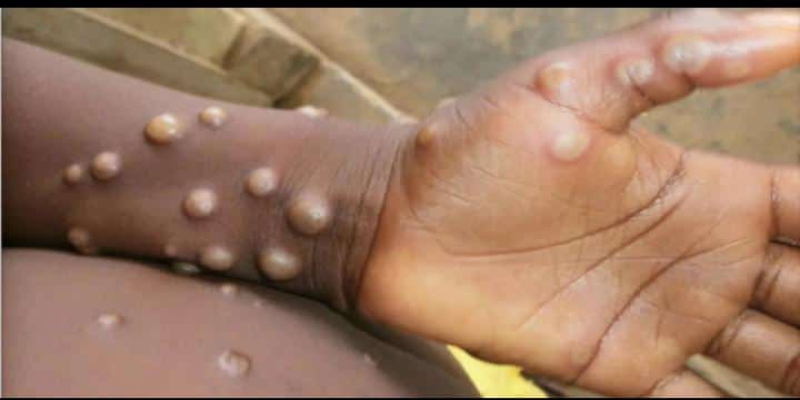 Symptômes de Mpox